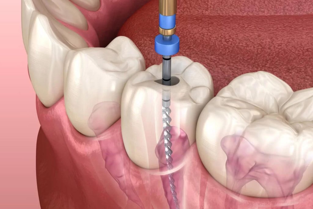 Endodoncia en torrent