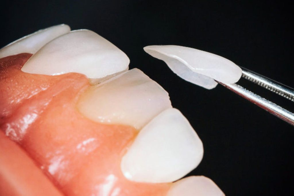 Carillas de porcelana y Fundas de cerámica