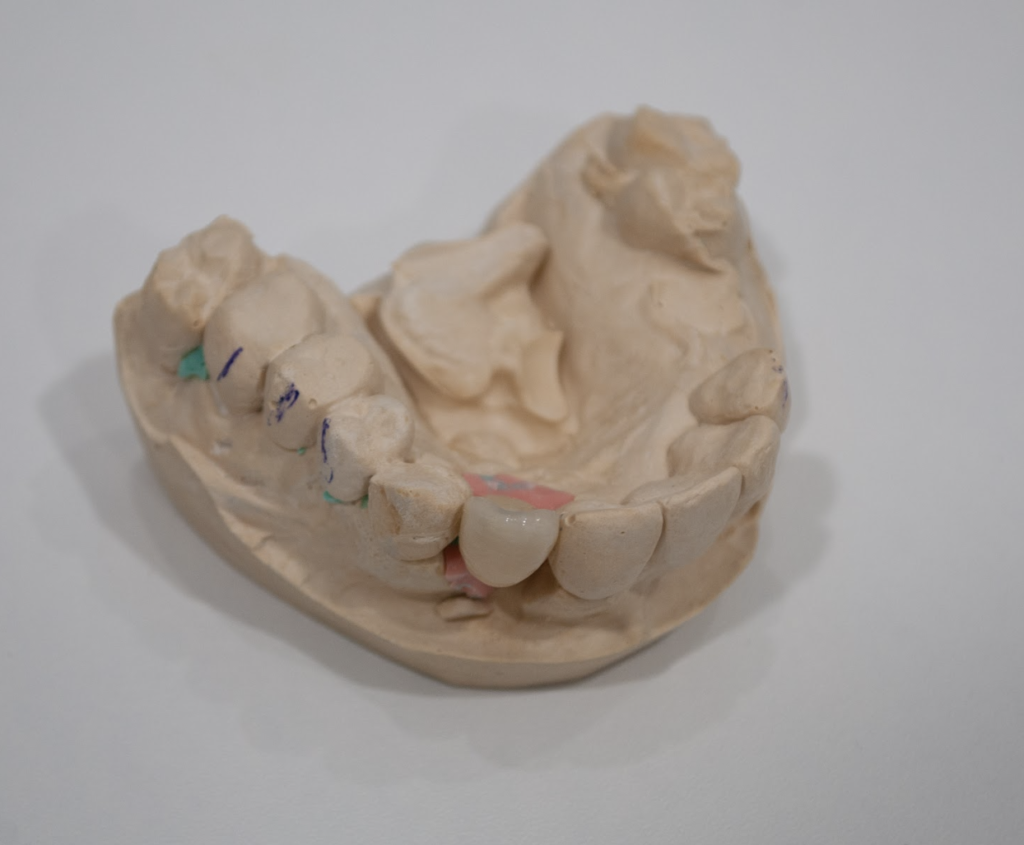 Prótesis Dental en Torrent